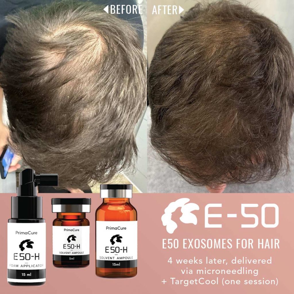 Hair Loss Treatment