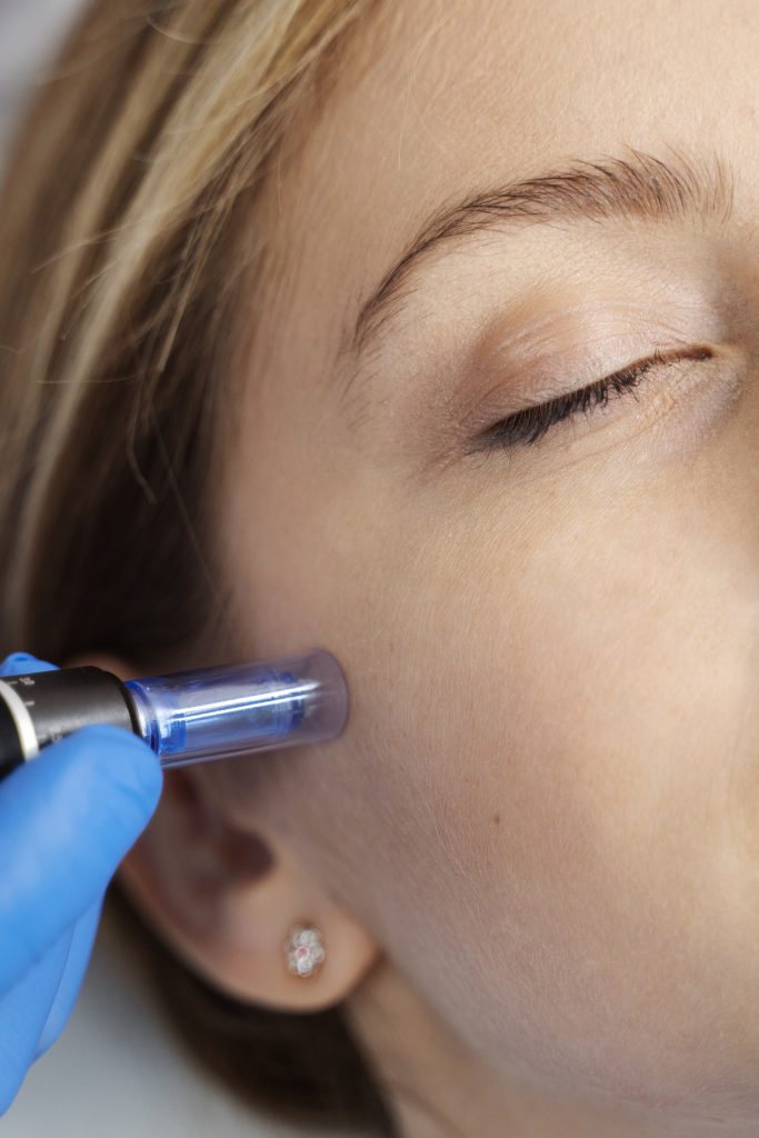 Microneedling